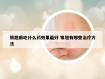 银翘癣吃什么药效果最好 银翘有哪些治疗方法