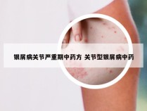 银屑病关节严重期中药方 关节型银屑病中药