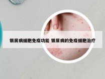 银屑病细胞免疫功能 银屑病的免疫细胞治疗