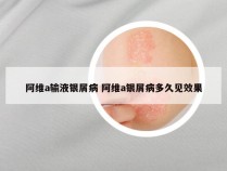 阿维a输液银屑病 阿维a银屑病多久见效果