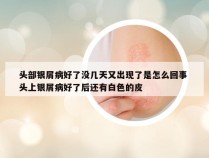 头部银屑病好了没几天又出现了是怎么回事 头上银屑病好了后还有白色的皮