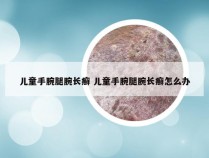 儿童手腕腿腕长癣 儿童手腕腿腕长癣怎么办