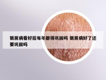 银屑病看好后每年都得巩固吗 银屑病好了还要巩固吗