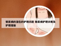 银屑病的潜在的护理问题 银屑病护理诊断及护理措施