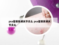 psa是银屑病关节炎么 psa是银屑病关节炎么