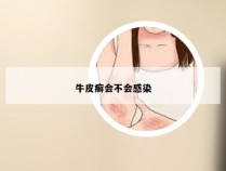 牛皮癣会不会感染