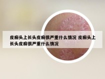 皮癣头上长头皮癣很严重什么情况 皮癣头上长头皮癣很严重什么情况