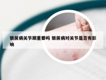 银屑病关节跟重要吗 银屑病对关节是否有影响