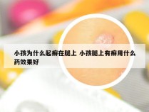 小孩为什么起癣在腿上 小孩腿上有癣用什么药效果好