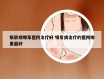 银屑病哪家医院治疗好 银屑病治疗的医院哪里最好