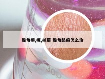 鬓角癣,痒,掉屑 鬓角起癣怎么治