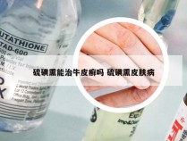 硫磺熏能治牛皮癣吗 硫磺熏皮肤病