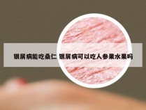 银屑病能吃桑仁 银屑病可以吃人参果水果吗