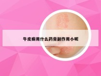 牛皮癣用什么药膏副作用小呢