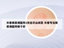 长春银屑病医院1快选华山诚恳 长春专治银屑病医院哪个好