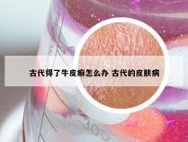 古代得了牛皮癣怎么办 古代的皮肤病