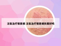 注氧治疗银屑病 注氧治疗银屑病效果好吗