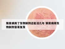 银屑病用了生物制剂还能活几年 银屑病用生物制剂容易复发