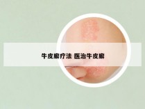 牛皮廨疗法 医治牛皮廨