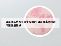 山东什么地方有治牛皮癣的 山东哪家医院治疗银屑病最好