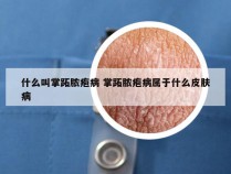 什么叫掌跖脓疱病 掌跖脓疱病属于什么皮肤病