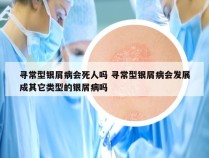 寻常型银屑病会死人吗 寻常型银屑病会发展成其它类型的银屑病吗