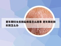 更年期妇女皮肤起癣是怎么回事 更年期皮肤长斑怎么办