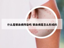 什么是银血病传染吗 银血病是怎么形成的