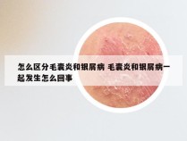 怎么区分毛囊炎和银屑病 毛囊炎和银屑病一起发生怎么回事