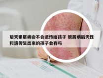 后天银屑病会不会遗传给孩子 银屑病后天性和遗传生出来的孩子会有吗