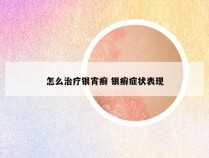 怎么治疗银宵癣 银癣症状表现