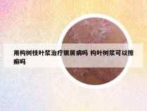 用构树枝叶浆治疗银屑病吗 构叶树浆可以擦癣吗