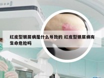 红皮型银屑病是什么导致的 红皮型银屑病有生命危险吗