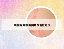 鳞屑癣 鳞屑癣图片及治疗方法