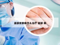 面部皮肤癣怎么治疗 面部 癣