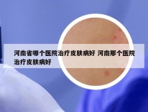 河南省哪个医院治疗皮肤病好 河南那个医院治疗皮肤病好