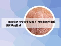 广州哪些医院专治牛皮癣 广州哪家医院治疗银屑病的最好