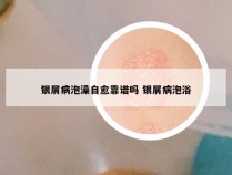 银屑病泡澡自愈靠谱吗 银屑病泡浴