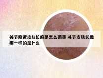 关节附近皮肤长癣是怎么回事 关节皮肤长像癣一样的是什么