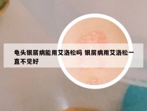 龟头银屑病能用艾洛松吗 银屑病用艾洛松一直不见好