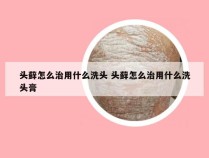 头藓怎么治用什么洗头 头藓怎么治用什么洗头膏