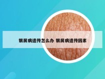 银屑病遗传怎么办 银屑病遗传因素