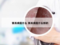 银肖病是什么 银肖病是什么样的