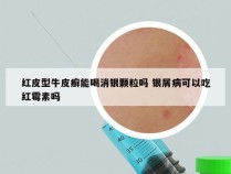 红皮型牛皮癣能喝消银颗粒吗 银屑病可以吃红霉素吗