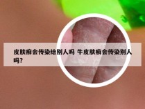 皮肤癣会传染给别人吗 牛皮肤癣会传染别人吗?