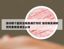 潍坊哪个医院治银屑病疗效好 潍坊银屑病研究院看银屑病怎么样