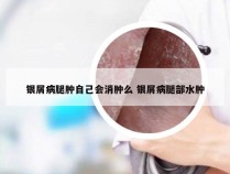 银屑病腿肿自己会消肿么 银屑病腿部水肿