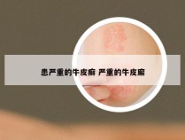 患严重的牛皮癣 严重的牛皮廨