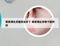 银屑病北京医院治好了 银屑病北京哪个医院好