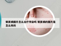 银屑病图片怎么治疗传染吗 银屑病的图片是怎么样的